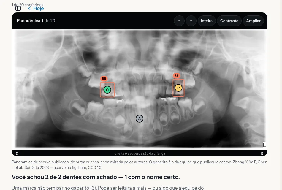 Captura da leitura de panorâmica: radiografia real de uma criança, publicada por pesquisadores.